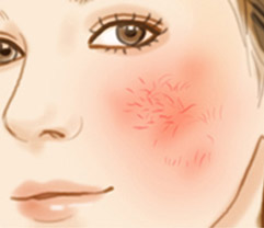 激素依赖性皮炎治疗期间的脸干，脱皮怎么缓解？
