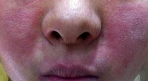 嘴巴周围冒痘红肿也是激素依赖性皮炎吗?