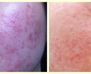 皮肤反复瘙痒起疹子，是过敏还是激素依赖性皮炎?