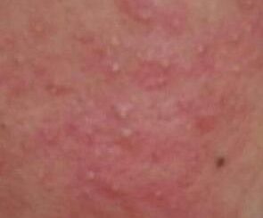 激素皮炎遇热红肿烫起疹子是因为角质层薄弱皮肤屏障受损吗？