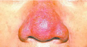 “草莓鼻”是玫瑰痤疮还是激素脸？鼻子红肿、毛孔粗大、黑头多该怎么修复治疗？