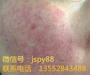 北京星光门诊部快讯：激素依赖性皮炎的治疗指南