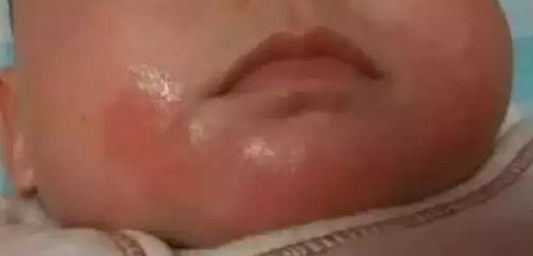 口周皮炎属于痤疮还是激素皮炎？嘴周围爆皮起痘痘如何进行治疗护理？