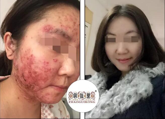 赵桂荣治疗激素脸的恢复周期，怎样才知道激素皮炎是否在好转？