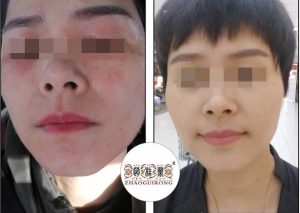 油皮、闭口粉刺是激素脸症状还是敏感肌？赵桂荣门诊如何治疗粉刺激素脸？