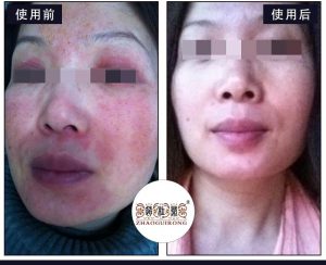 赵桂荣中医修复激素脸与皮肤屏障|激素皮炎是皮肤组织结构哪一层出了问题？