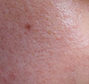激素脸面部出现红斑是代表皮炎严重了吗？激素脸有哪些处理办法?
