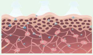 激素皮炎皮肤受刺激的反应程度与什么有关?