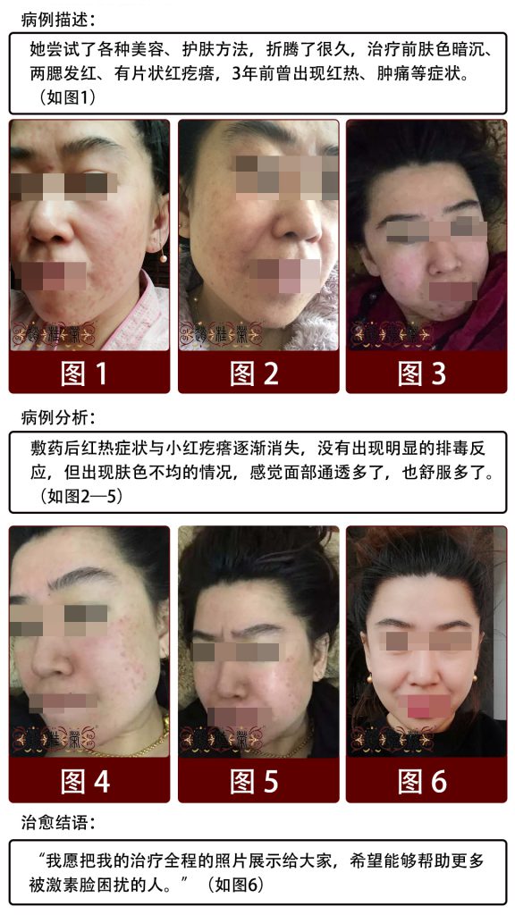 赵桂荣：面部激素依赖性皮炎可以用护肤品吗？