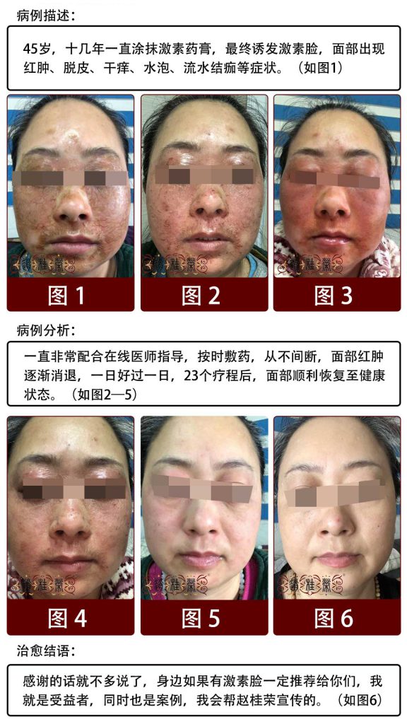 面部激素依赖性皮炎可以用护肤品吗？