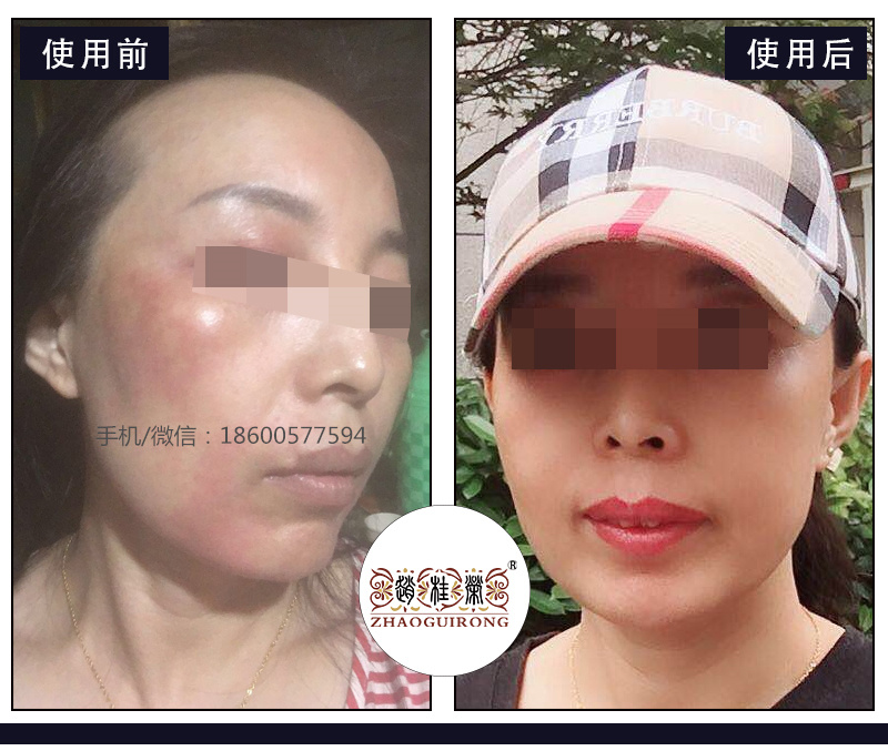 赵桂荣：面部皮肤水肿、红肿的激素依赖性皮炎该如何治疗？